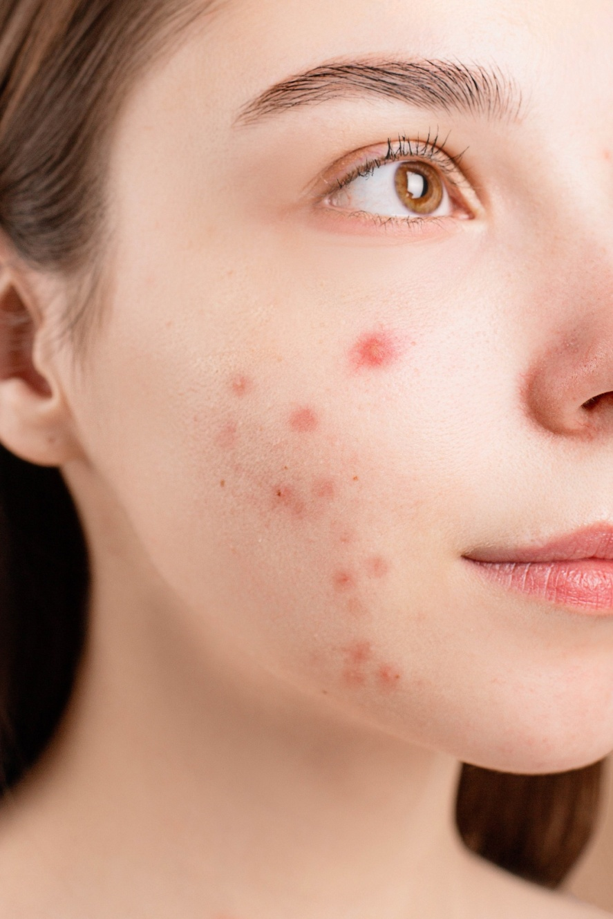 A woman with acne on her face