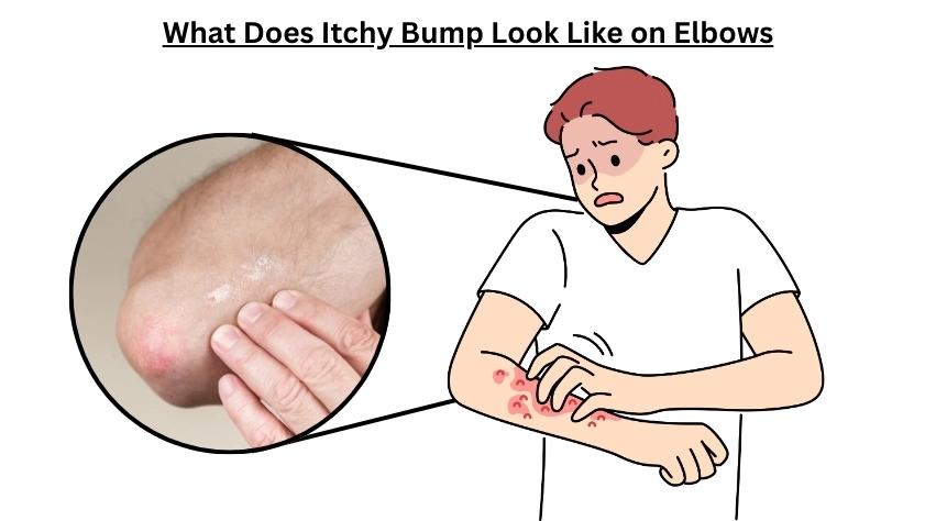 bumps-on-elbows