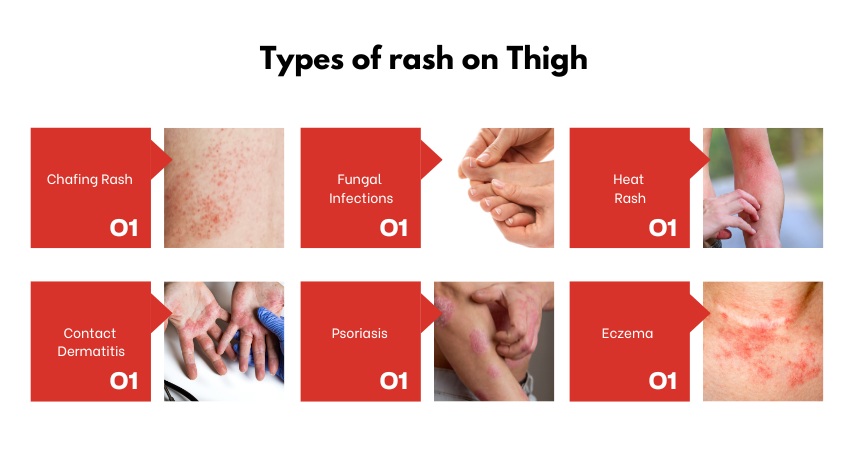 rash-on-inner-thigh-causes-treatments-fastdocnow